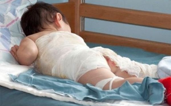 Сэрэмжлүүлэг: Бага насны хүүхдүүд буузны усанд түлэгдэж байна