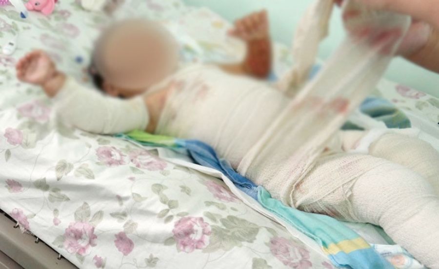 Сэрэмжлүүлэг: Бага насны хүүхдүүд түлэгдэж, шатаж нас баржээ