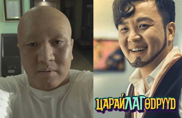 Жүжигчин Э.Мөнхтөр үс халцардаг өвчин туссан талаараа ингэж тайлбарлав