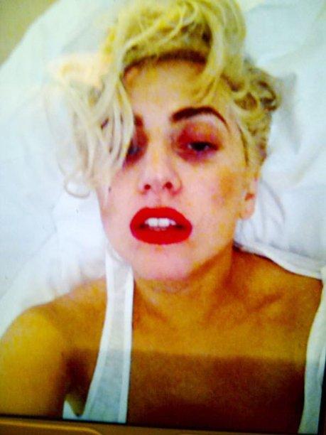 Лэди Гага хөхөрсөн нүүрээ харууллаа